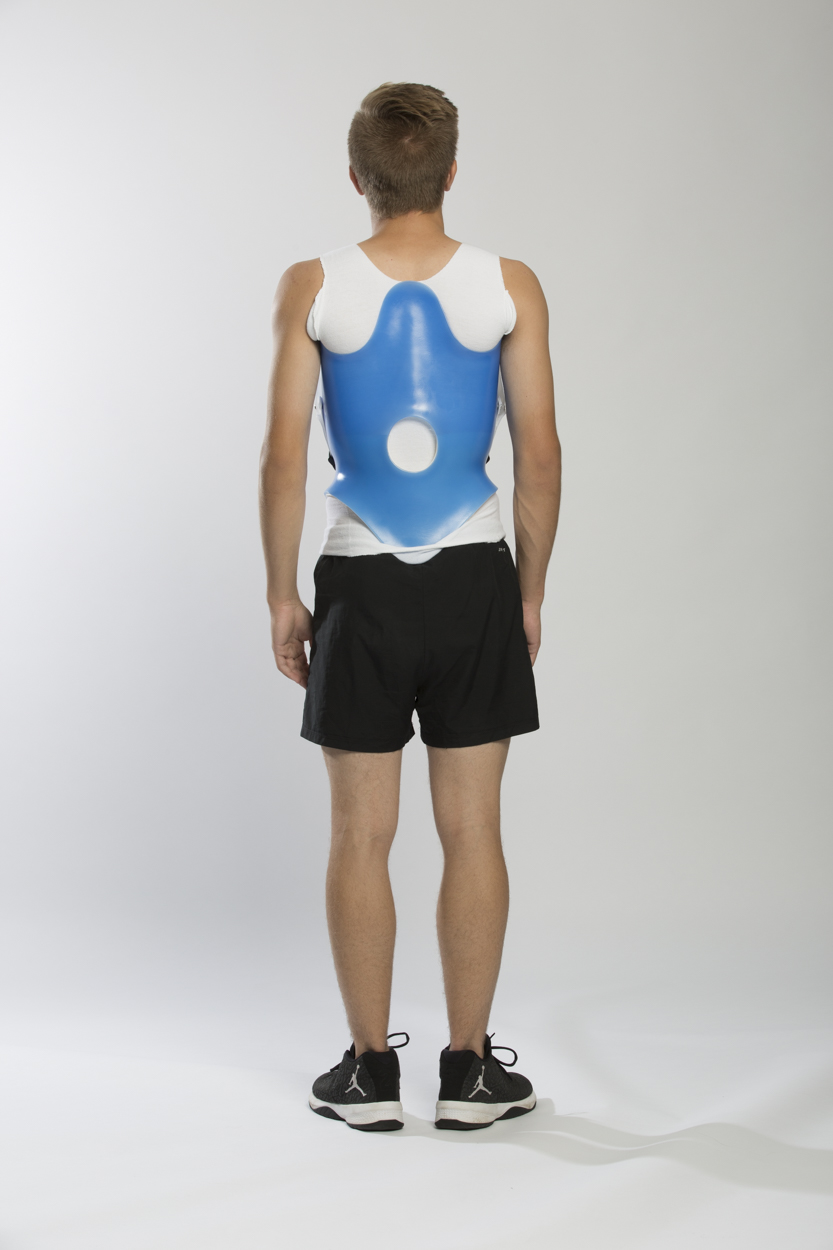 scoliosis diagnosis treatment