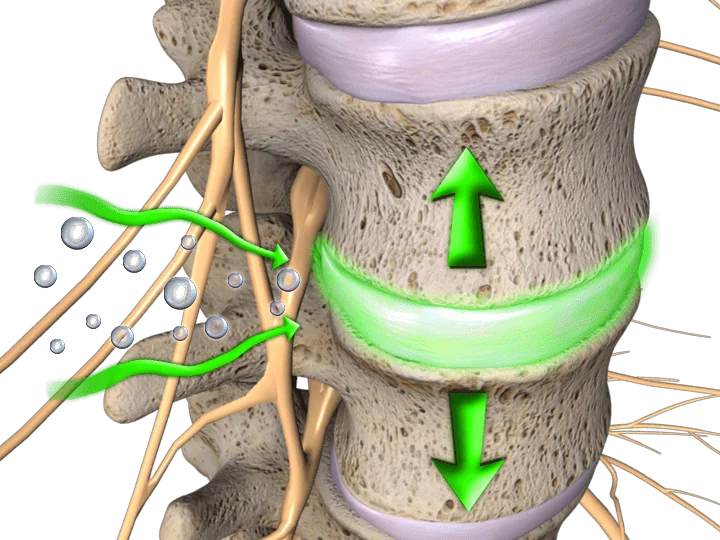 decompression spine therapy - Hatfield Chiropractic Care -  - Decompression Spine Therapy for Back Pain Relief - Decompression spine therapy helps relieve pressure on the spine, reducing pain and improving mobility. Discover how this non-surgical treatment works. - 